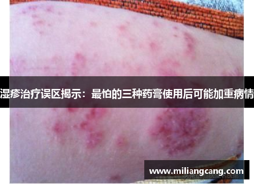 湿疹治疗误区揭示:最怕的三种药膏使用后可能加重病情 湿疹治疗误区揭示:最怕的三种药膏使用后可能加重病情